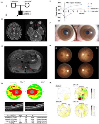 Acute-Onset Visual Impairment in Wilson's Disease: A Case Report and Literature Review